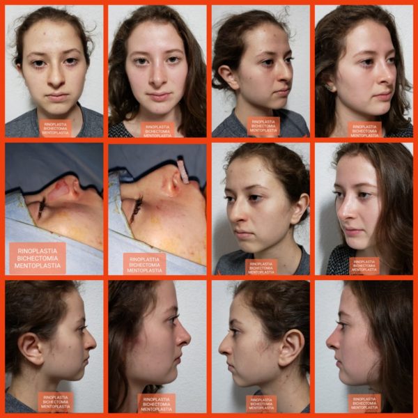 rinoplastia-600×600